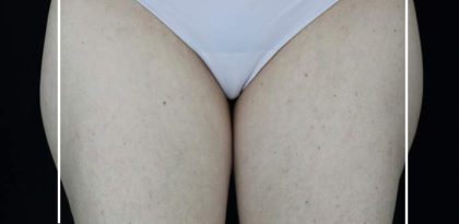 Cellulite & Stretchmarks Before & After Patient #16555