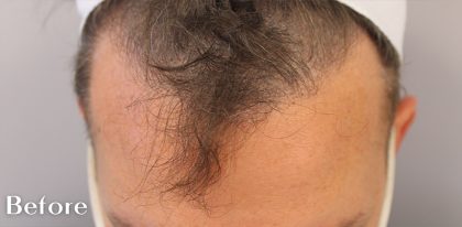 Hair Restoration Before & After Patient #16718