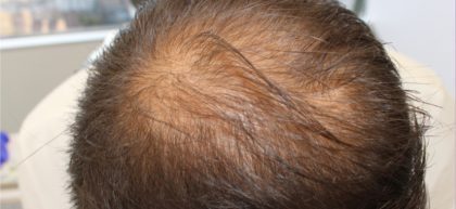 Hair Restoration Before & After Patient #16719