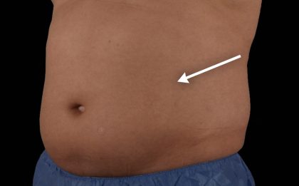 Abdominal Contouring Before & After Patient #16648