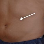 Abdominal Contouring Before & After Patient #16648