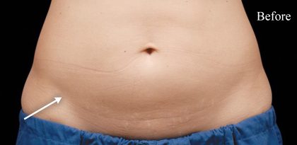 Abdominal Contouring Before & After Patient #16647
