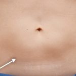 Abdominal Contouring Before & After Patient #16647
