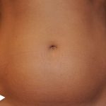 Abdominal Contouring Before & After Patient #16646