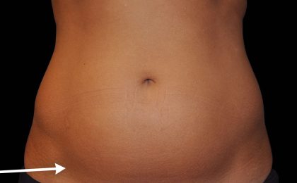 Abdominal Contouring Before & After Patient #16646