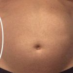Abdominal Contouring Before & After Patient #16645