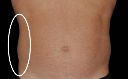 Abdominal Contouring Before & After Patient #16645