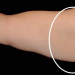 Arm Liposuction Before & After Patient #16644