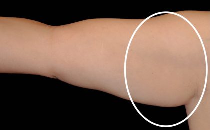 Arm Liposuction Before & After Patient #16644