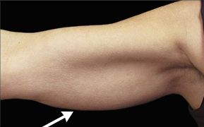 Arm Liposuction Before & After Patient #16643