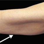 Arm Liposuction Before & After Patient #16643