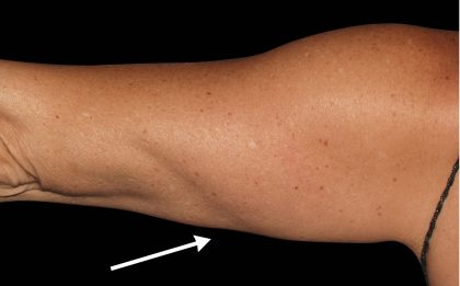 Arm Liposuction Before & After Patient #16642