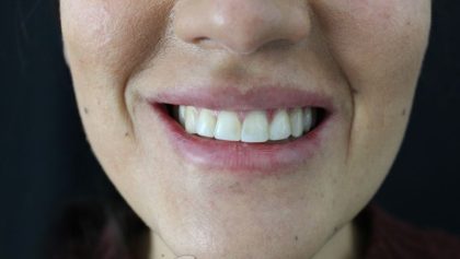 Gummy Smiles Before & After Patient #16714