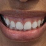 Gummy Smiles Before & After Patient #16717