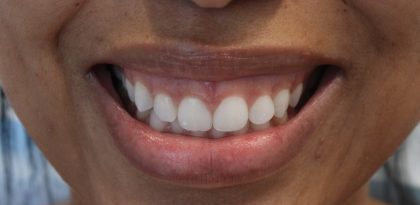 Gummy Smiles Before & After Patient #16717