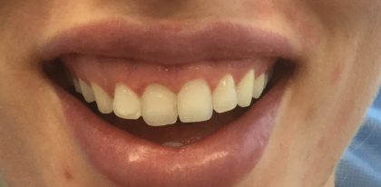 Gummy Smiles Before & After Patient #16716