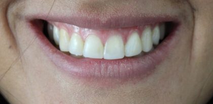 Gummy Smiles Before & After Patient #16715