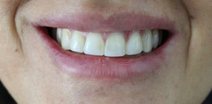 Gummy Smiles Before & After Patient #16715