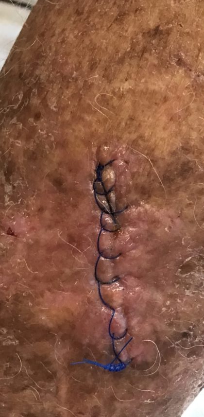 Skin Cancer & Mohs Before & After Patient #16651