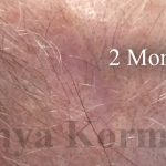 Skin Cancer & Mohs Before & After Patient #16652