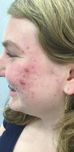 Redness & Rosacea Before & After Patient #16989