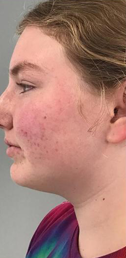 Redness & Rosacea Before & After Patient #16989