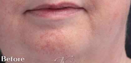 Redness & Rosacea Before & After Patient #16995