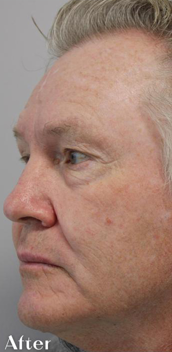 Redness & Rosacea Before & After Patient #16996