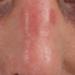 Redness & Rosacea Before & After Patient #16982