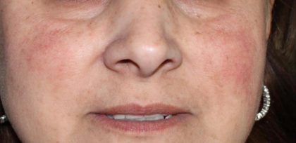 Redness & Rosacea Before & After Patient #16983