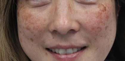 Redness & Rosacea Before & After Patient #16984