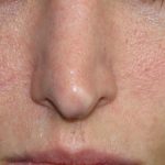 Redness & Rosacea Before & After Patient #16985
