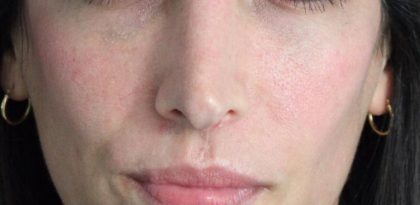 Redness & Rosacea Before & After Patient #16985