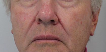 Redness & Rosacea Before & After Patient #16986