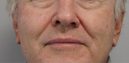 Redness & Rosacea Before & After Patient #16986