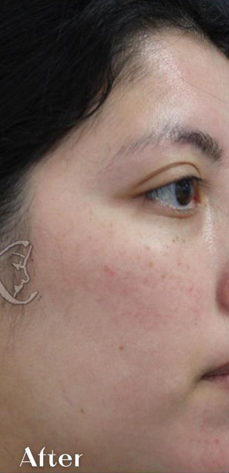 Redness & Rosacea Before & After Patient #16988