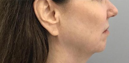 Skin Tightening Before & After Patient #16903