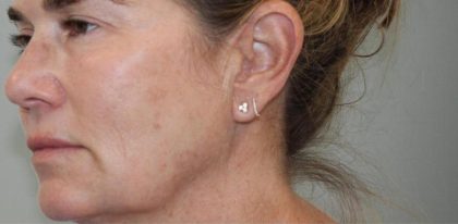 Skin Tightening Before & After Patient #16905