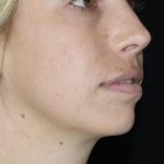 Skin Tightening Before & After Patient #16907