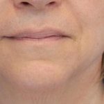 Skin Tightening Before & After Patient #16914