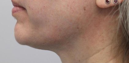 Skin Tightening Before & After Patient #16916