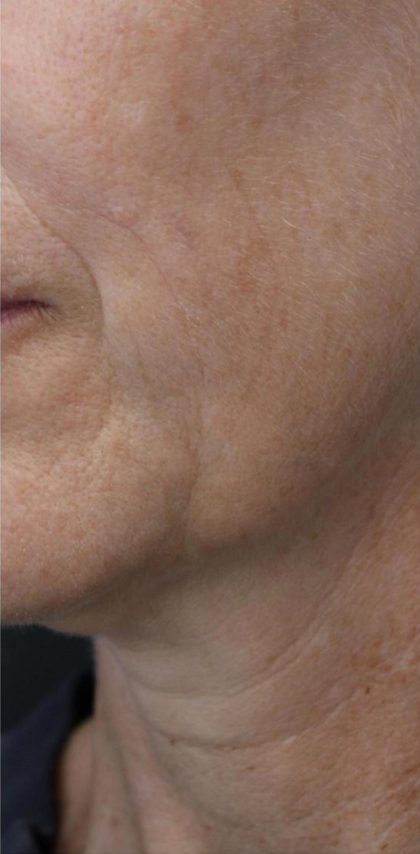 Skin Tightening Before & After Patient #16921