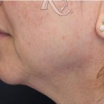 Skin Tightening Before & After Patient #16923