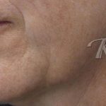 Skin Tightening Before & After Patient #16924