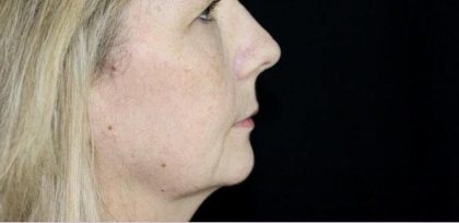 Skin Tightening Before & After Patient #16930