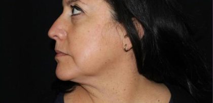 Skin Tightening Before & After Patient #16895