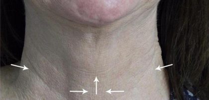Skin Tightening Before & After Patient #16934