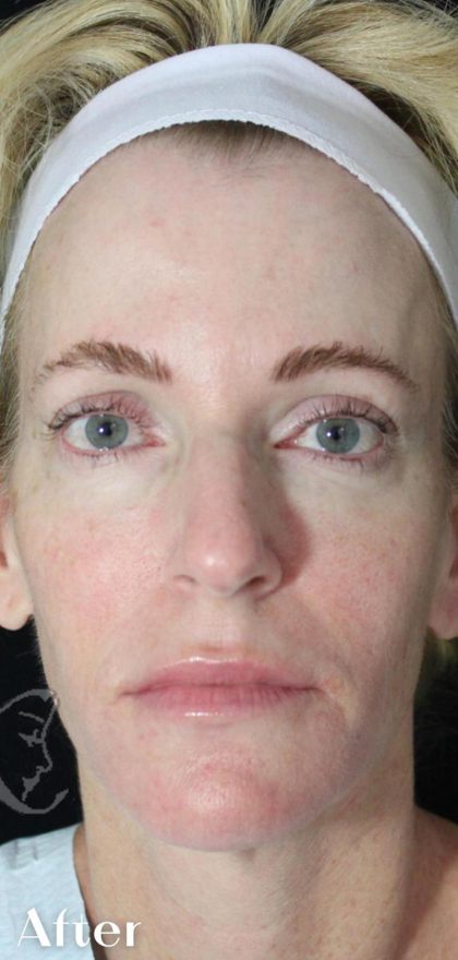 Skin Tightening Before & After Patient #16935