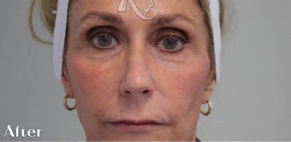 Skin Tightening Before & After Patient #16936