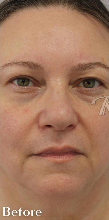 Skin Tightening Before & After Patient #16939